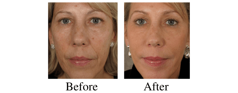 Liquid Facelift before and after photos