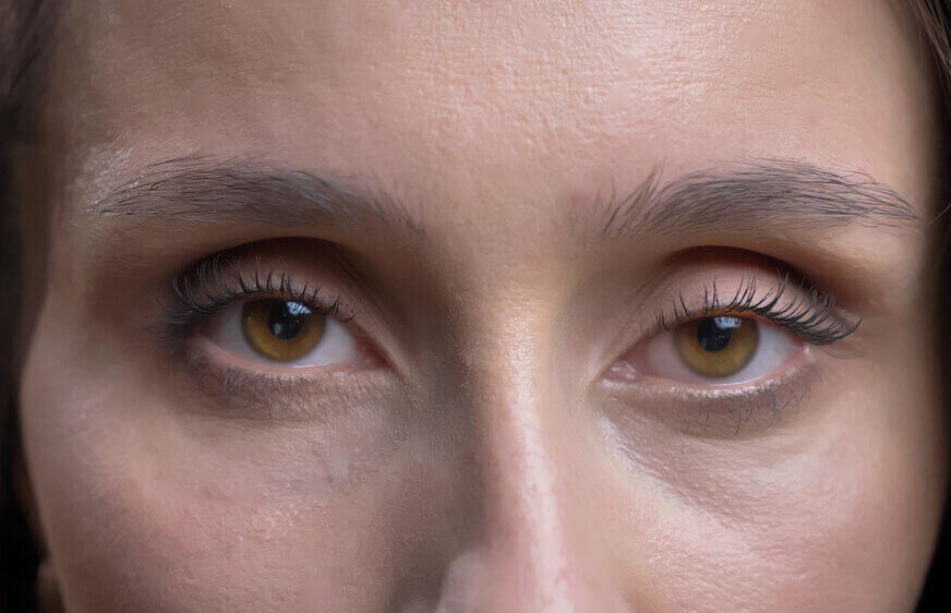Closeup of woman with ptosis