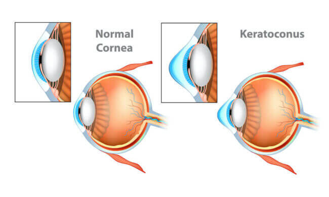 Keratoconus diagram